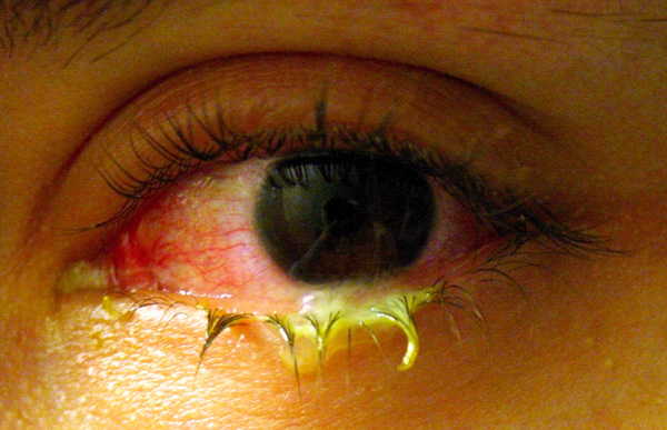 Papillomavirus a l oeil - Les cancers ORL