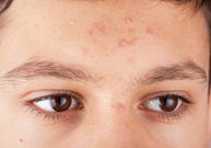 acné, adolescent, points noirs, kystes blancs, rétinoïdes, peroxyde de benzoyle, Propionibacterium acnes